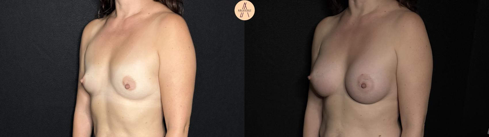 Before & After Breast Augmentation Case 293 Left Oblique View in San Antonio, Texas
