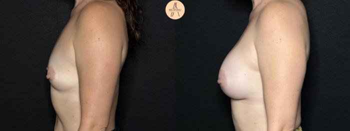 Before & After Breast Augmentation Case 293 Left Side View in San Antonio, Texas