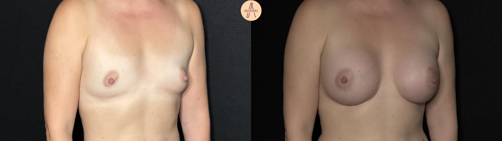 Before & After Breast Augmentation Case 293 Right Oblique View in San Antonio, Texas