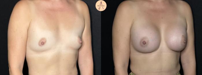 Before & After Breast Augmentation Case 293 Right Oblique View in San Antonio, Texas