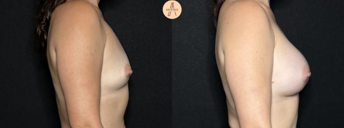 Before & After Breast Augmentation Case 293 Right Side View in San Antonio, Texas