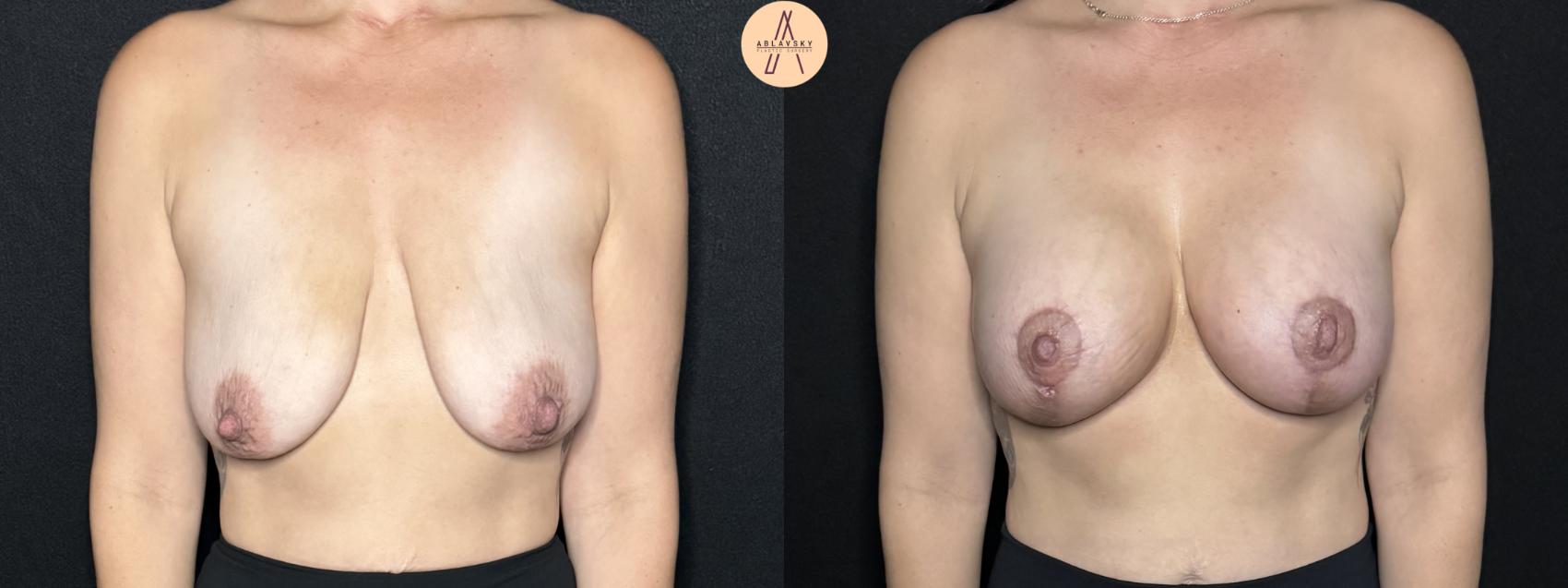 Before & After Breast Augmentation Case 301 Front View in San Antonio, Texas