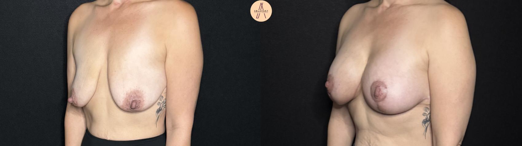 Before & After Breast Lift Case 301 Left Oblique View in San Antonio, Texas
