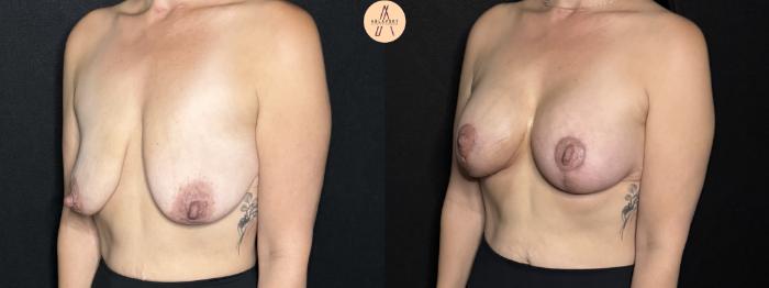 Before & After Breast Augmentation Case 301 Left Oblique View in San Antonio, Texas