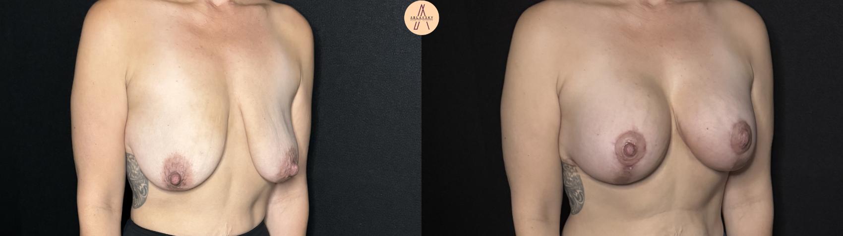 Before & After Breast Lift Case 301 Right Oblique View in San Antonio, Texas