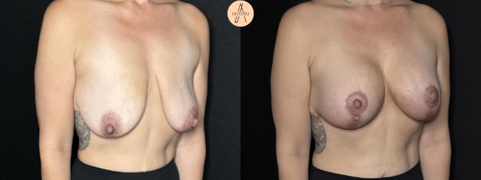 Before & After Breast Augmentation Case 301 Right Oblique View in San Antonio, Texas