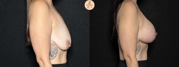 Before & After Breast Augmentation Case 301 Right Side View in San Antonio, Texas