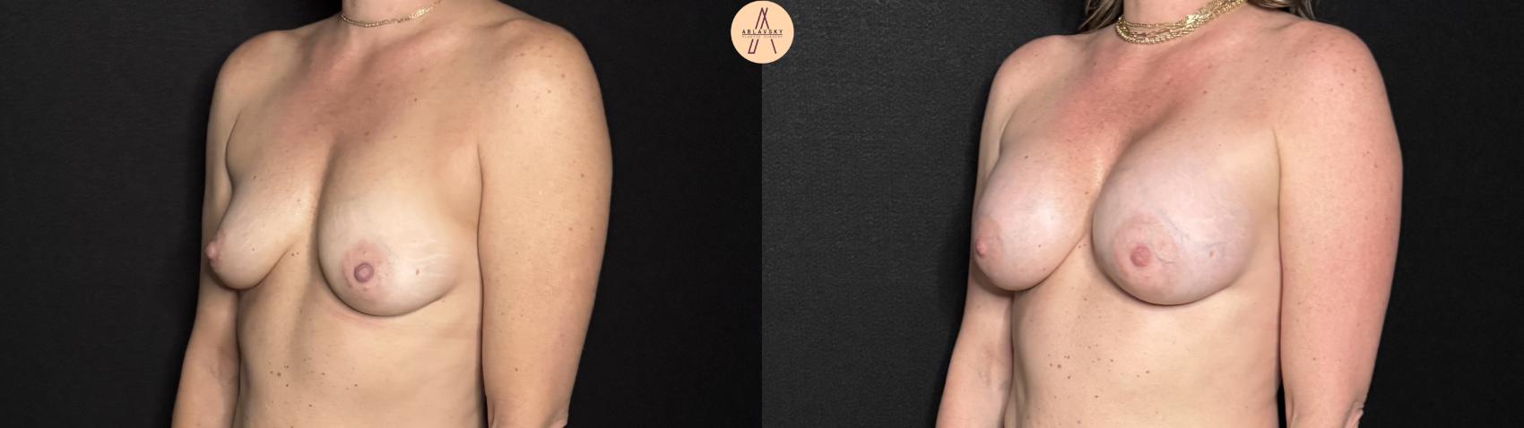 Before & After Breast Augmentation Case 314 Left Oblique View in San Antonio, Texas