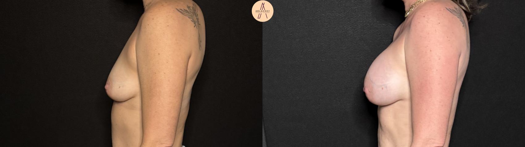 Before & After Breast Augmentation Case 314 Left Side View in San Antonio, Texas