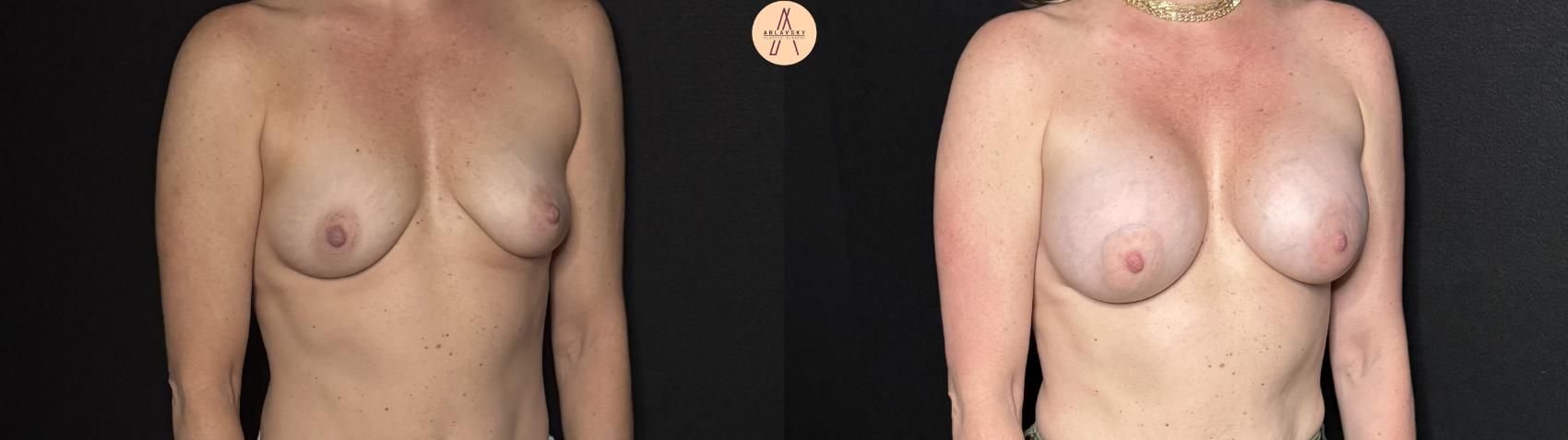 Before & After Breast Augmentation Case 314 Right Oblique View in San Antonio, Texas