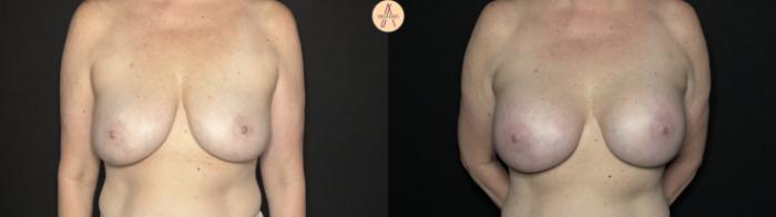 Before & After Breast Augmentation Case 326 Front View in San Antonio, Texas