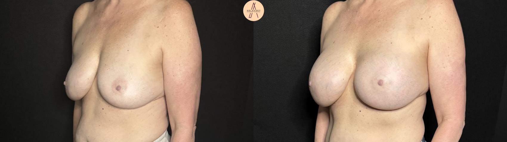 Before & After Breast Augmentation Case 326 Left Oblique View in San Antonio, Texas