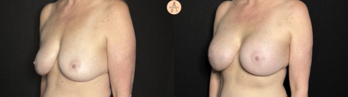 Before & After Breast Augmentation Case 326 Left Oblique View in San Antonio, Texas