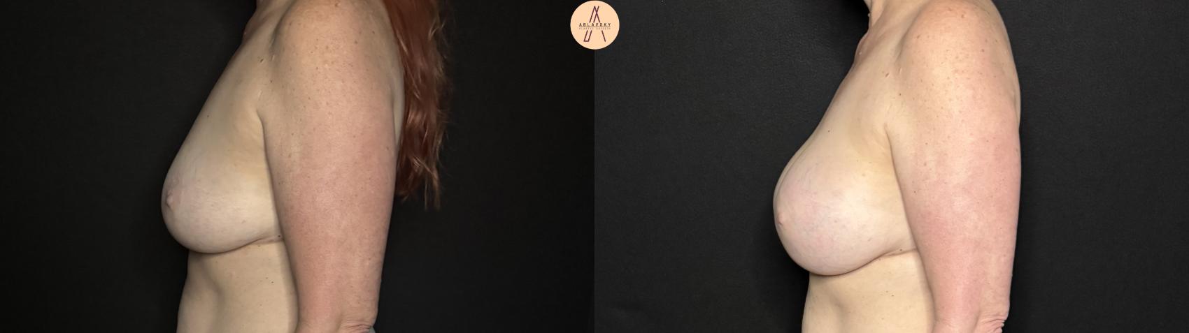 Before & After Breast Augmentation Case 326 Left Side View in San Antonio, Texas