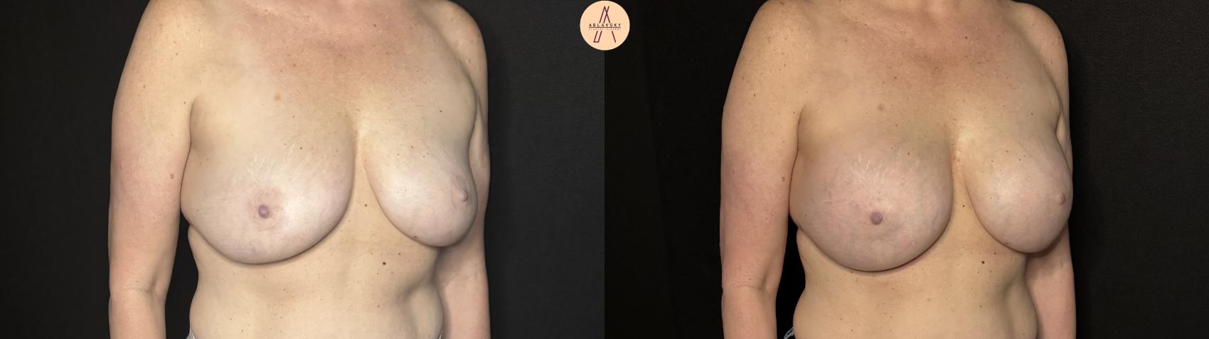 Before & After Breast Augmentation Case 326 Right Oblique View in San Antonio, Texas