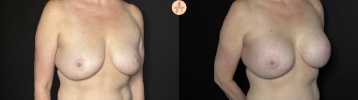 Before & After Breast Augmentation Case 326 Right Oblique View in San Antonio, Texas