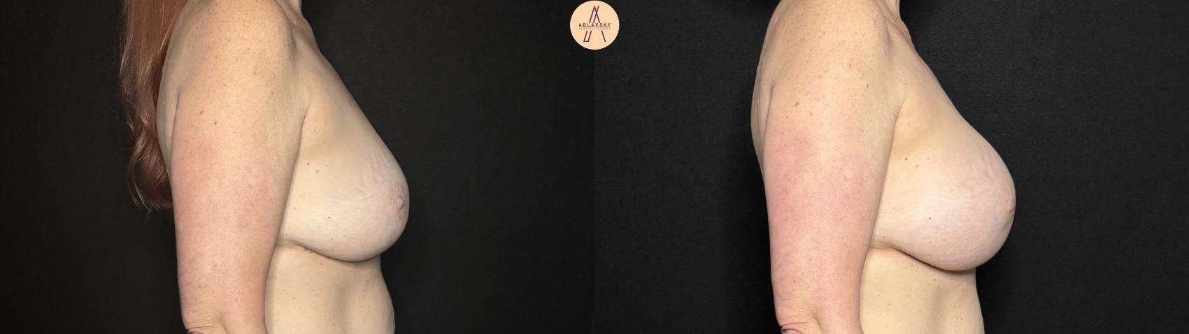 Before & After Breast Augmentation Case 326 Right Side View in San Antonio, Texas