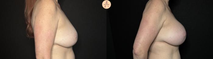 Before & After Breast Augmentation Case 326 Right Side View in San Antonio, Texas