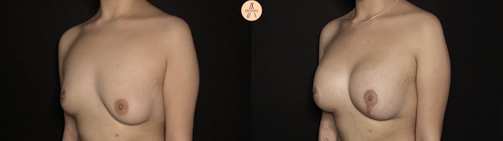 Before & After Breast Augmentation Case 358 Left Oblique View in San Antonio, Texas
