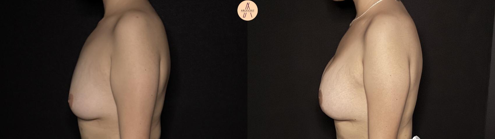 Before & After Breast Augmentation Case 358 Left Side View in San Antonio, Texas