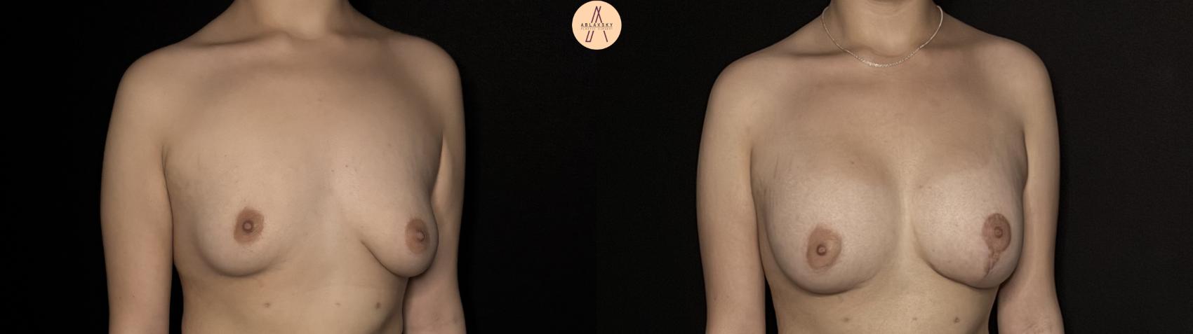 Before & After Breast Augmentation Case 358 Right Oblique View in San Antonio, Texas