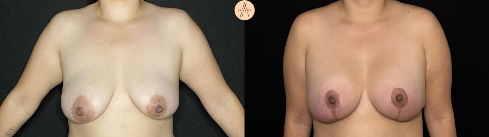 Before & After Breast Augmentation Case 419 Front View in San Antonio, Texas