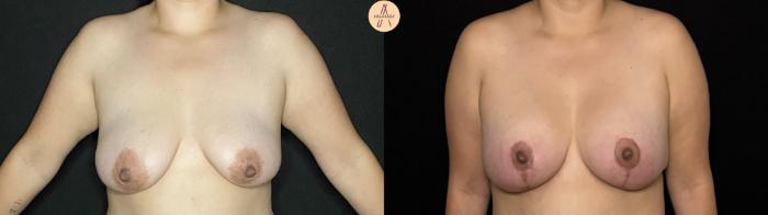 Before & After Breast Augmentation Case 419 Front View in San Antonio, Texas