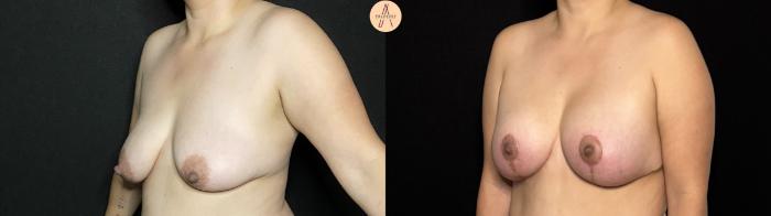 Before & After Breast Augmentation Case 419 Left Oblique View in San Antonio, Texas