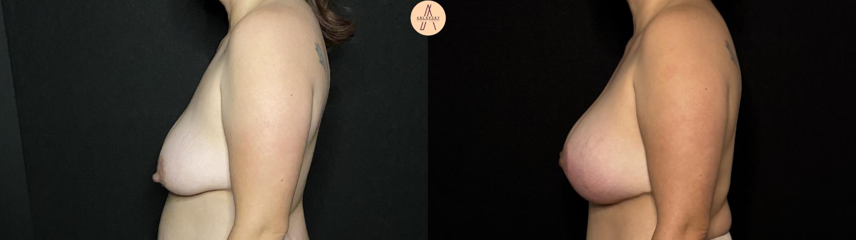 Before & After Breast Augmentation Case 419 Left Side View in San Antonio, Texas