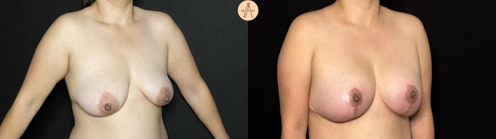 Before & After Breast Augmentation Case 419 Right Oblique View in San Antonio, Texas