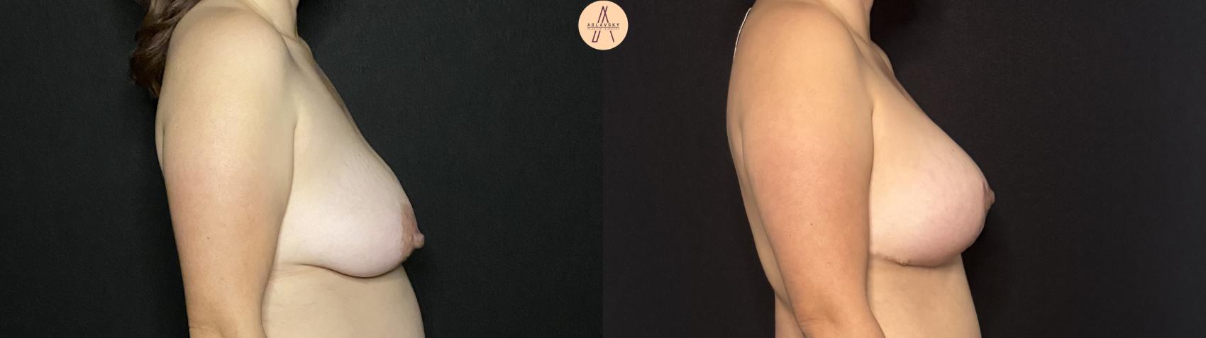 Before & After Breast Augmentation Case 419 Right Side View in San Antonio, Texas