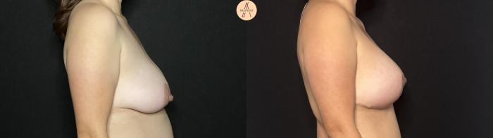 Before & After Breast Augmentation Case 419 Right Side View in San Antonio, Texas