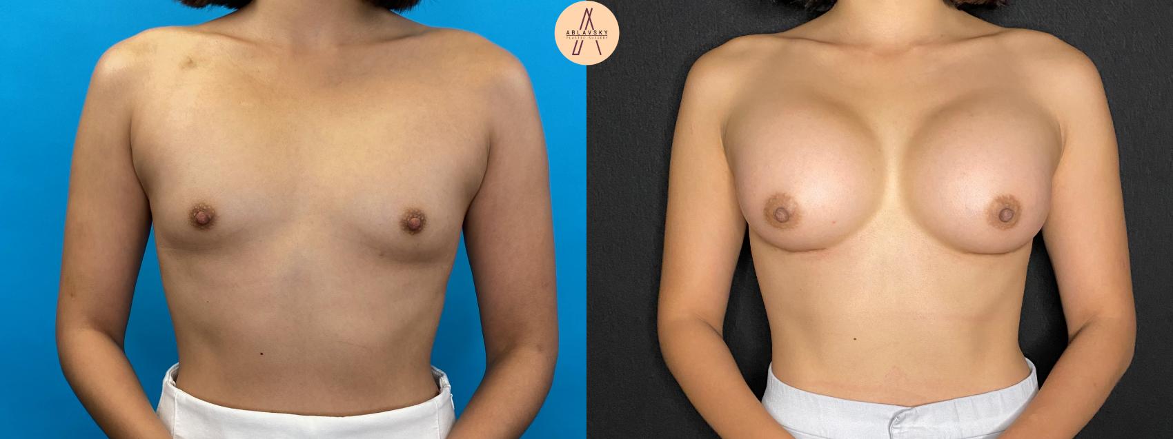 Before & After Breast Augmentation Case 42 Front View in San Antonio, Texas