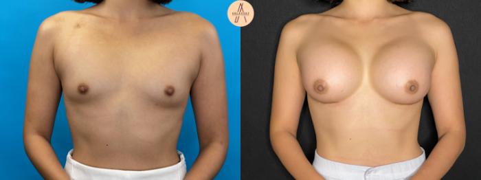 Before & After Breast Augmentation Case 42 Front View in San Antonio, Texas