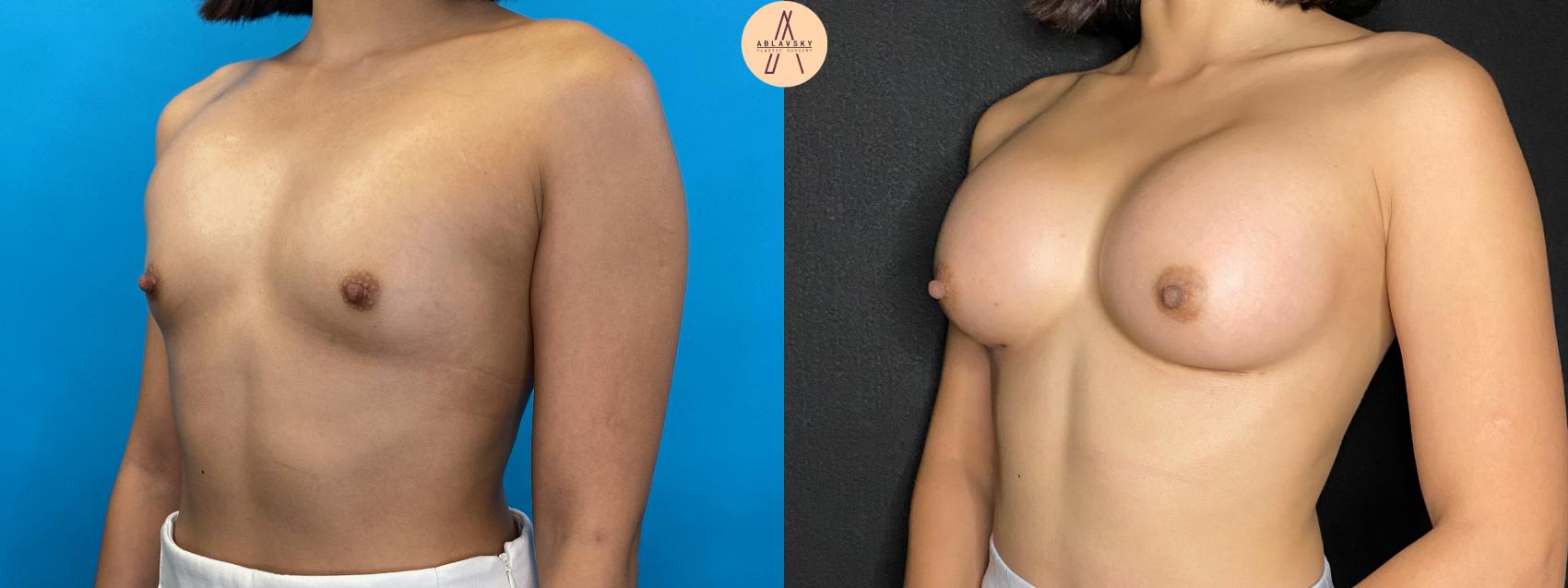 Before & After Breast Augmentation Case 42 Left Oblique View in San Antonio, Texas