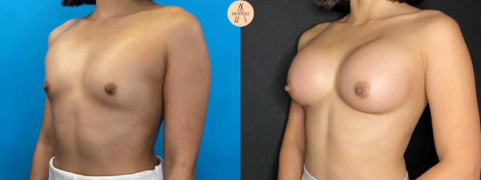 Before & After Breast Augmentation Case 42 Left Oblique View in San Antonio, Texas