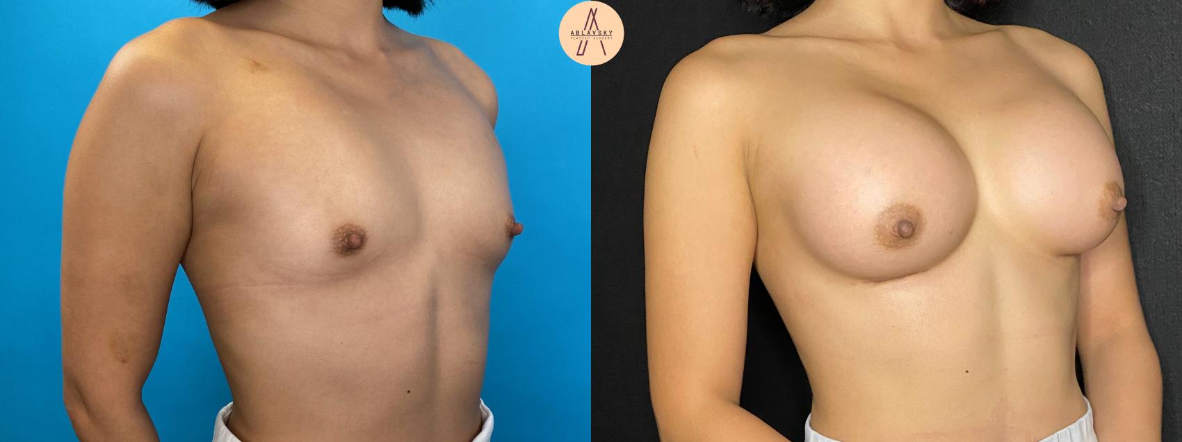 Before & After Breast Augmentation Case 42 Right Oblique View in San Antonio, Texas
