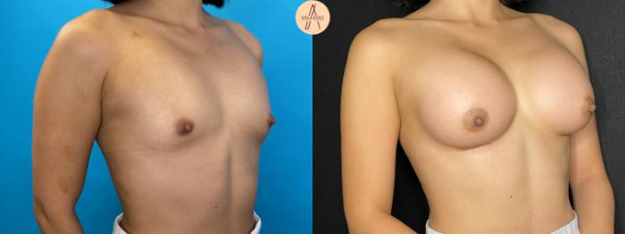 Before & After Breast Augmentation Case 42 Right Oblique View in San Antonio, Texas
