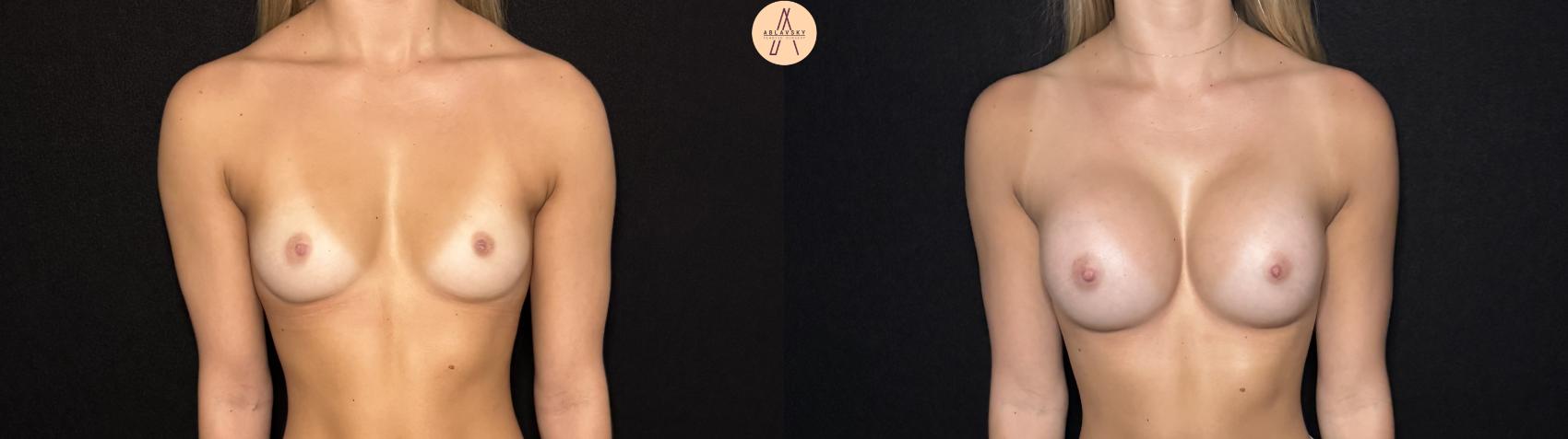 Before & After Breast Augmentation Case 426 Front View in San Antonio, Texas