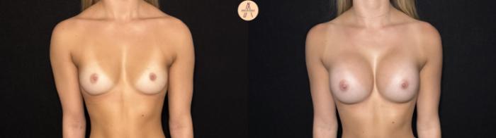 Before & After Breast Augmentation Case 426 Front View in San Antonio, Texas