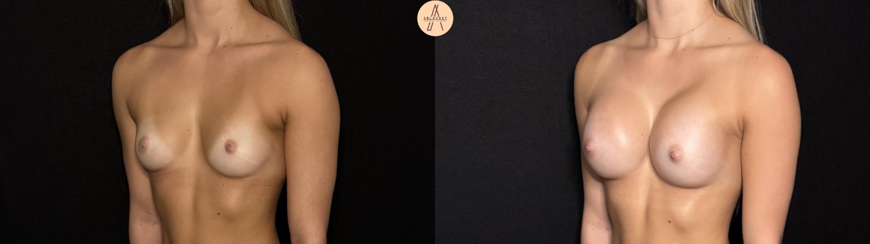 Before & After Breast Augmentation Case 426 Left Oblique View in San Antonio, Texas