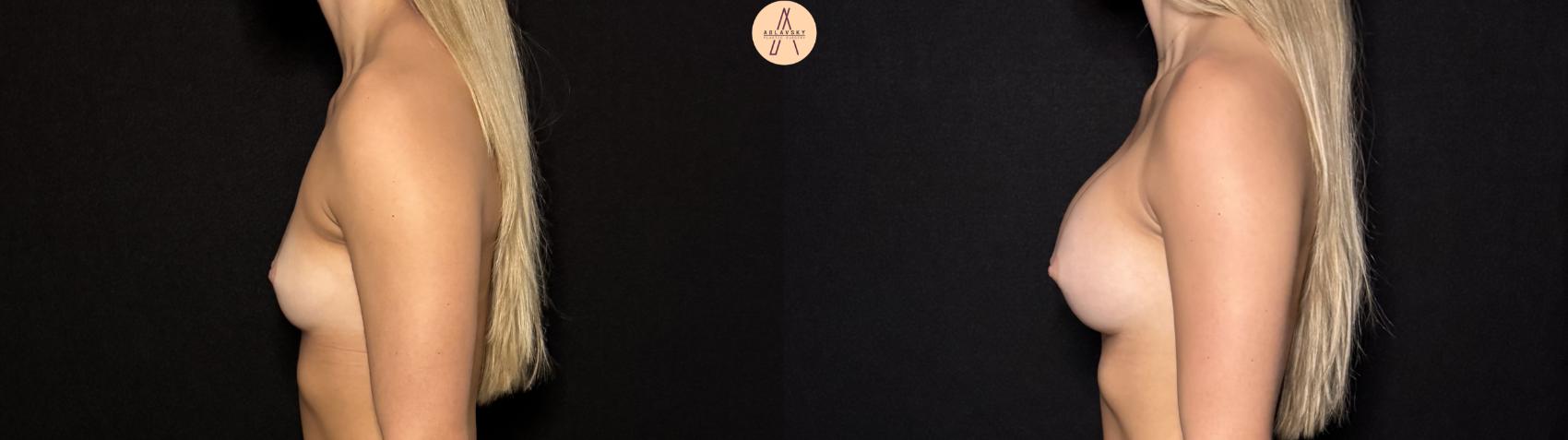 Before & After Breast Augmentation Case 426 Left Side View in San Antonio, Texas