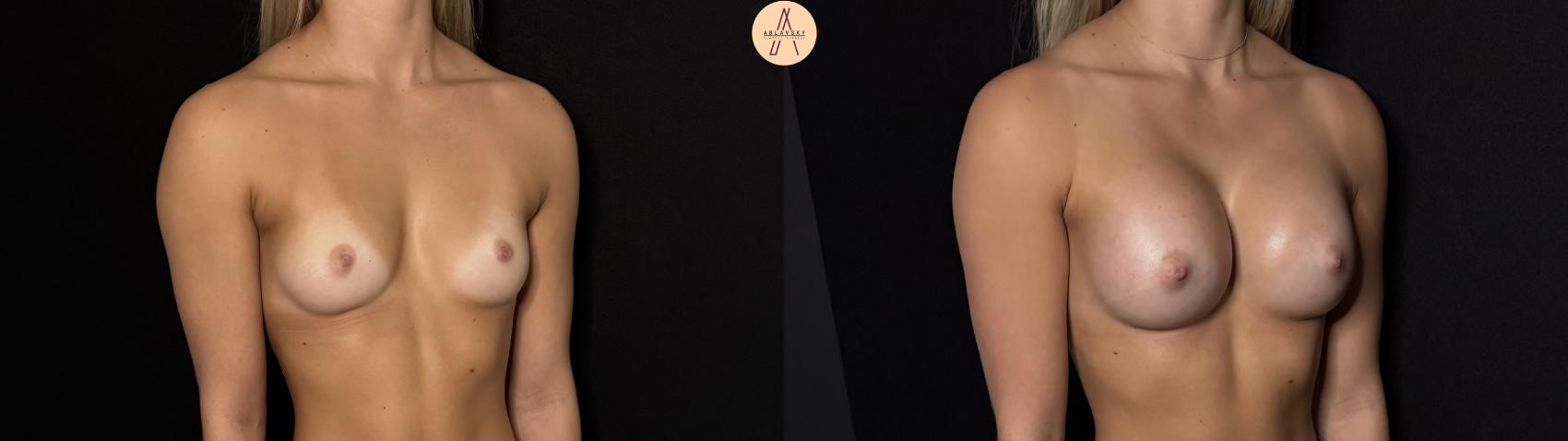 Before & After Breast Augmentation Case 426 Right Oblique View in San Antonio, Texas