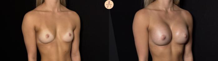 Before & After Breast Augmentation Case 426 Right Oblique View in San Antonio, Texas