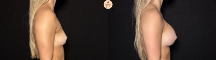 Before & After Breast Augmentation Case 426 Right Side View in San Antonio, Texas