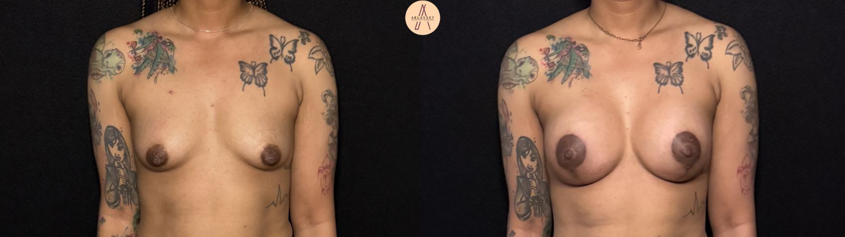 Before & After Breast Augmentation Case 442 Front View in San Antonio, Texas