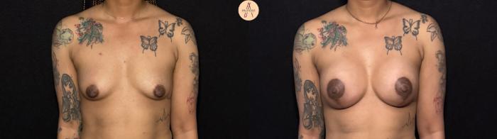 Before & After Breast Augmentation Case 442 Front View in San Antonio, Texas