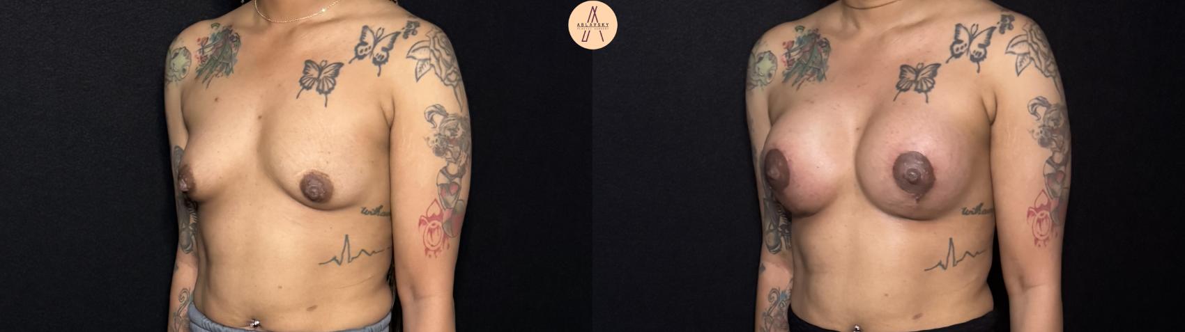 Before & After Breast Augmentation Case 442 Left Oblique View in San Antonio, Texas