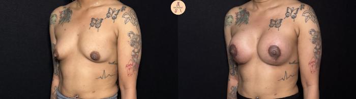 Before & After Breast Augmentation Case 442 Left Oblique View in San Antonio, Texas