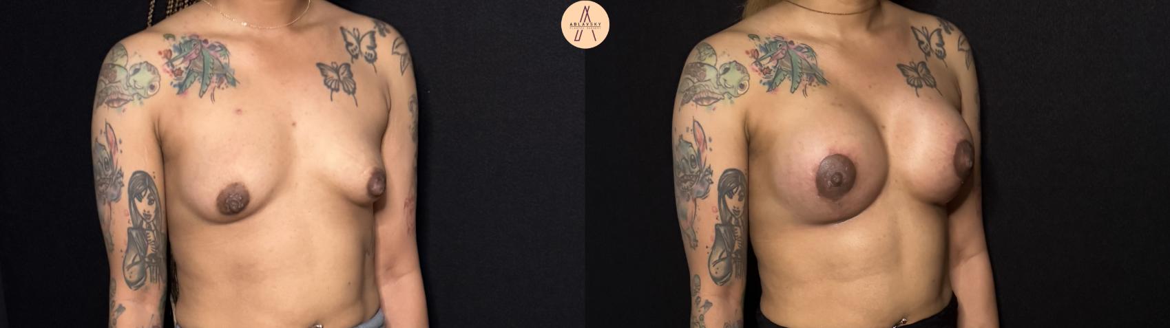Before & After Breast Augmentation Case 442 Right Oblique View in San Antonio, Texas